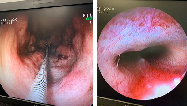 Biopsie et fibroscopie